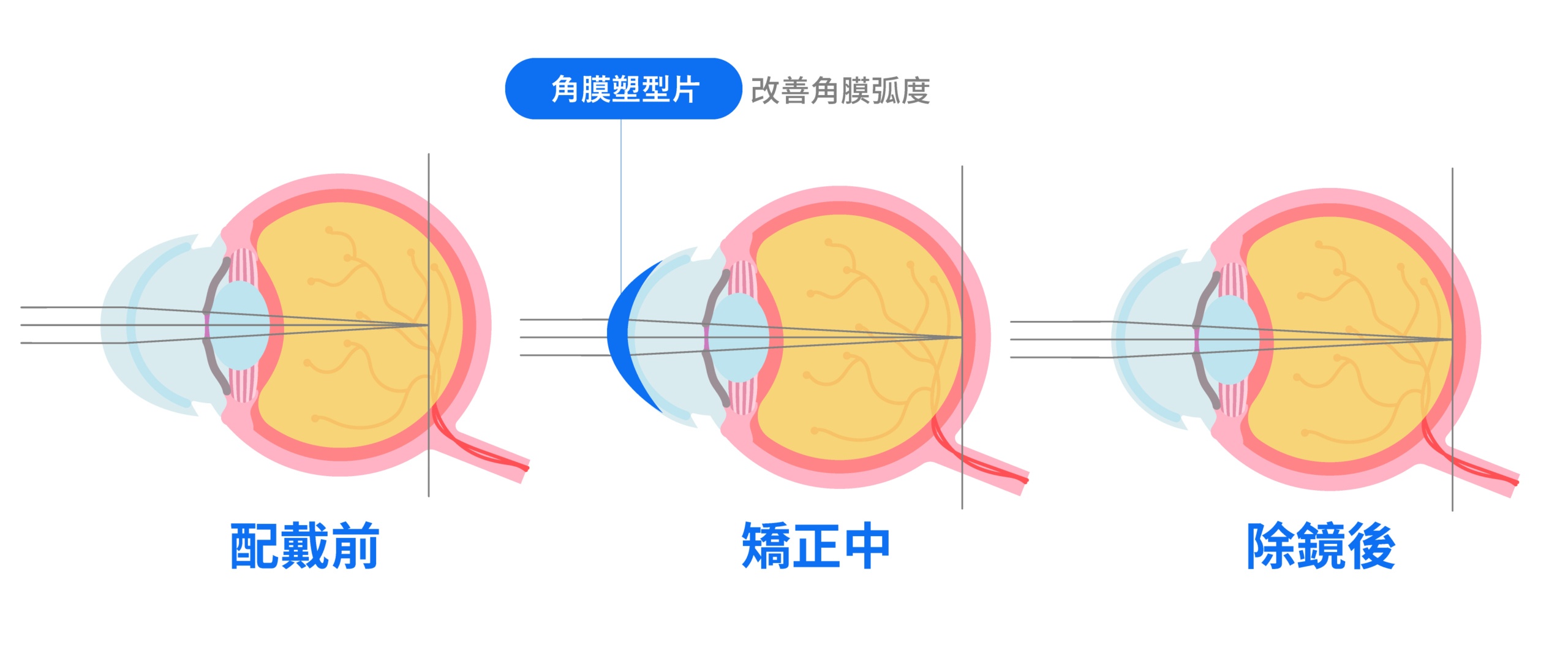 角膜塑型片 - 生殖醫學｜ 許越涵婦產科醫師